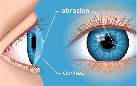 Cornea & external eye diseases unit – Eye Care Center