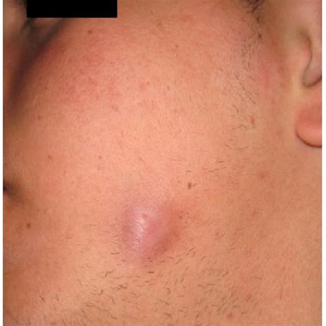 pre operative extraoral view   sinus tract   submandibular