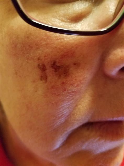 My mom's scab looks like a Llama : r/mildlyinteresting