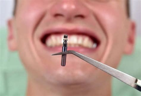 dental implants   philippines costs risks