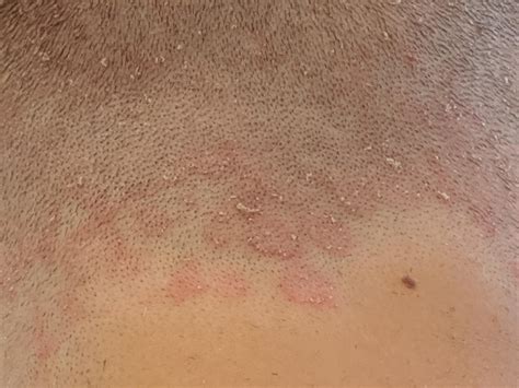 Scalp Rash And Bumps at Roy Lujan blog