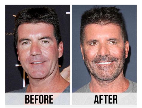 simon cowell plastic surgery unveiling  impact  cosmetic enhancement