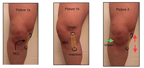 Physiotherapy spotlight: Knee MCL tears/ sprains | All For One