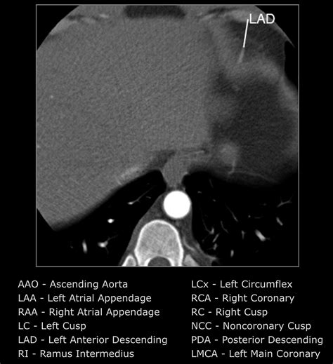 КТ коранорография — 24Radiology.ru