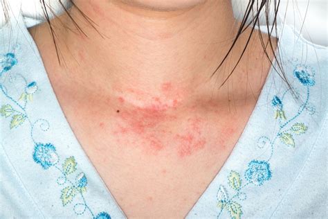 Rash 36 Common Skin Rashes Pictures Causes Treatment – eroppa