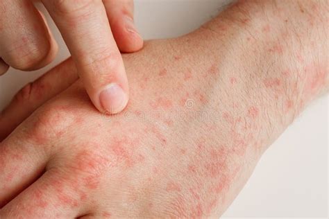 Hands with Allergy Reaction from Taking Medicines. by-effect ...