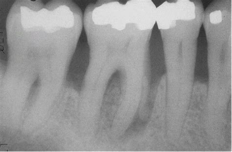 Advanced Adult Periodontitis. - MEDizzy