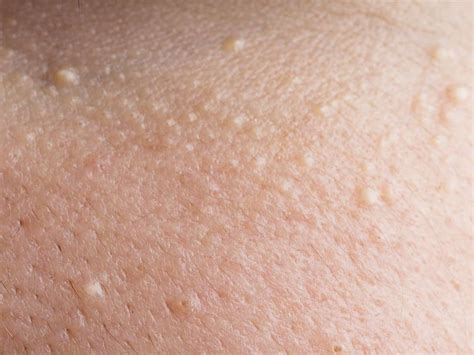 Skin Cancer White Spots On Face - CancerWalls