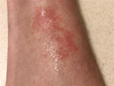 Sadbe rash or no? I know we aren’t dermatologists, just getting