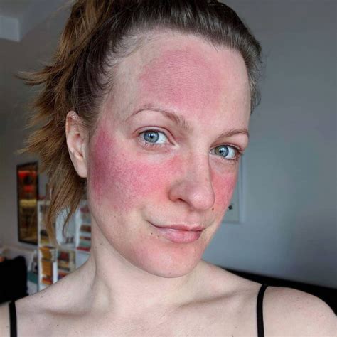 Cream For Mild Rosacea at Laura Strong blog