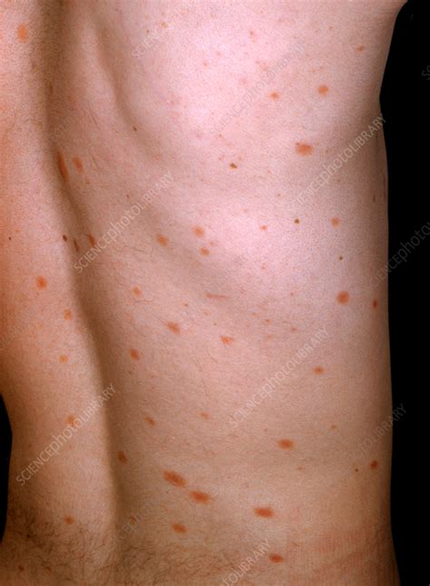 secondary syphilis stock image  science photo library