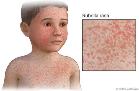 Nakakahawa Ba Ang Tigdas Hangin O German Measles?