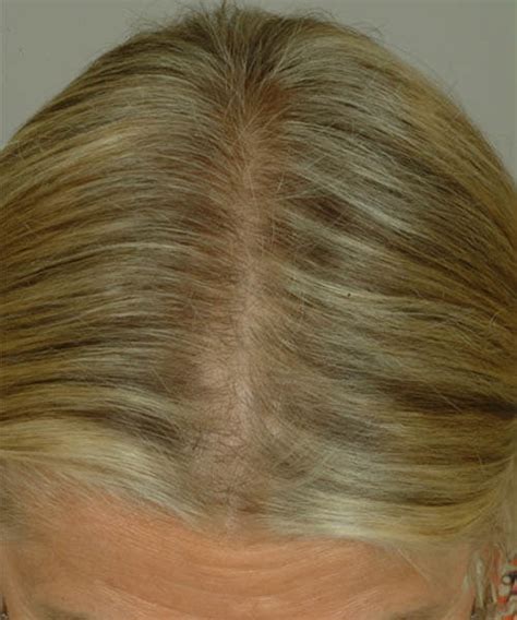 Hair Restoration Before and After | See Photos | LaserCap