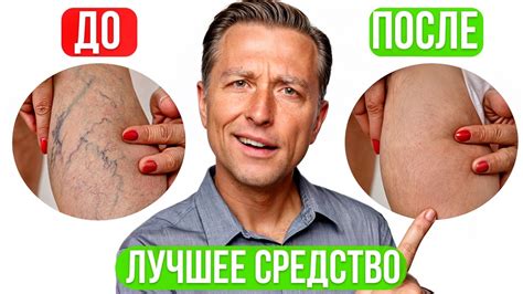 Таблетки от варикоза: лучшие препараты для лечения расширения вен на ...