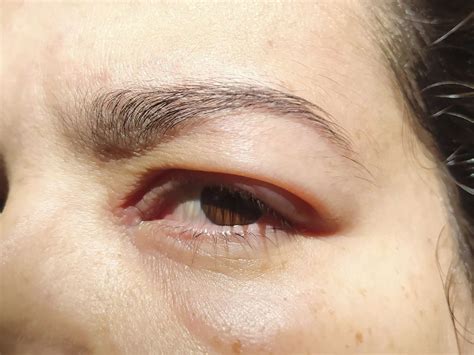 Causes Of Swollen Puffy Eyes In The Morning Reddit - Infoupdate.org