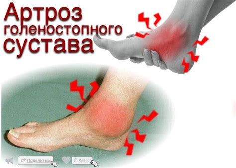 Лечение голеностопного сустава народными средствами - 36 рецептов!