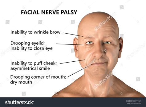 paralysis stock illustrations images vectors shutterstock