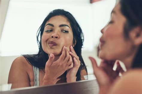 Learn What Excoriated Acne Is and How to Treat It