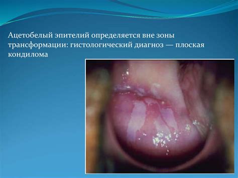 Папиломавирусная инфекция половых путей - презентация онлайн