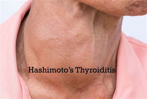 Symptoms Of Hashimoto Thyroiditis
