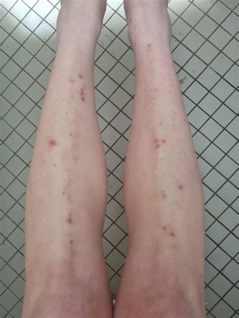 Dermatitis Herpetiformis Legs