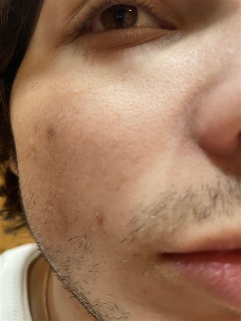 why is my face constantly red 1