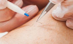 How Much Does Electrolysis Hair Removal Cost in 2025? [+ FAQs]