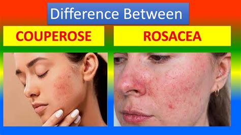 Difference Between Couperose and Rosacea - YouTube