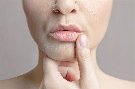 Woman with Dry Lips, Dry, Chapped, Peeling Lips, Dry Skin Problem with ...