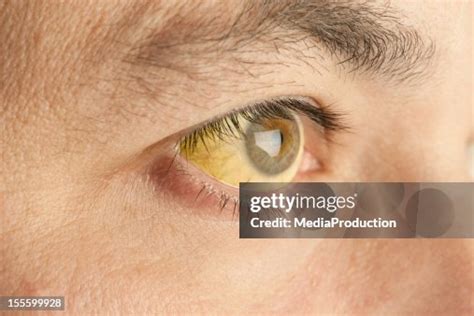 Jaundice High-Res Stock Photo - Getty Images