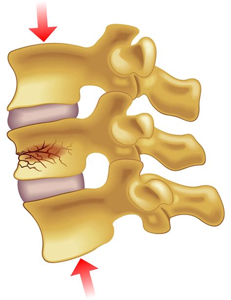 Vertebral Compression Fracture Treatment in NJ and NYC | Premier Brain ...