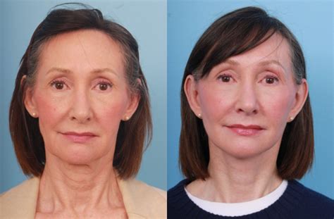 Lower Facelift | FacesFirst Cosmetic Surgery
