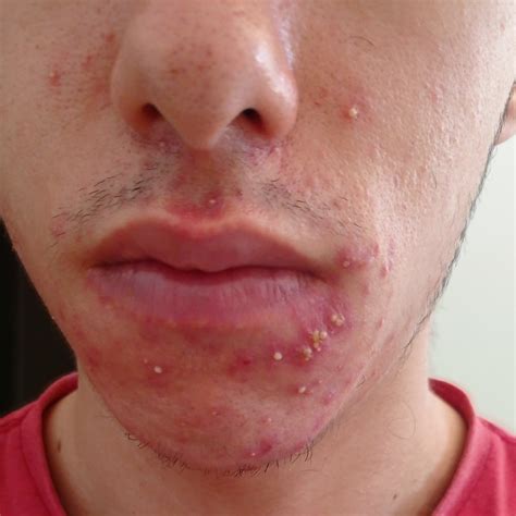 Whitehead outbreak that hurts A LOT [M20] : r/acne