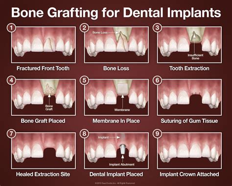 Bone Grafting for Dental Implants - Sherway Gardens Dental Centre
