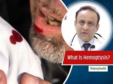Hemoptysis