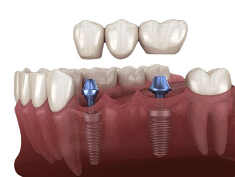 Same Day Implants – Dentetik | Dental Clinic in Istanbul / Turkey