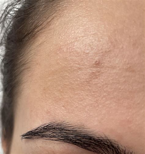 Forehead irritation. I have a forehead irritation.It apperead 2 days