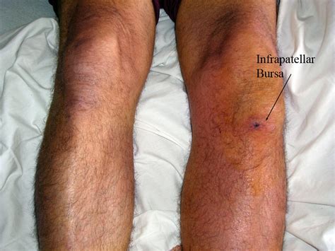 Prepatellar bursitis - wikidoc