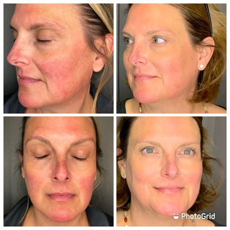 List 91+ Pictures Ipl Treatment Before And After Pictures Latest