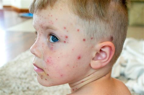 Adult Chicken Pox Stages