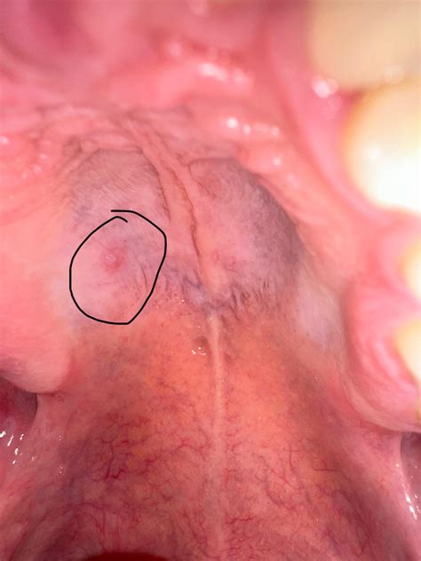 Roof Of Mouth Ulcer