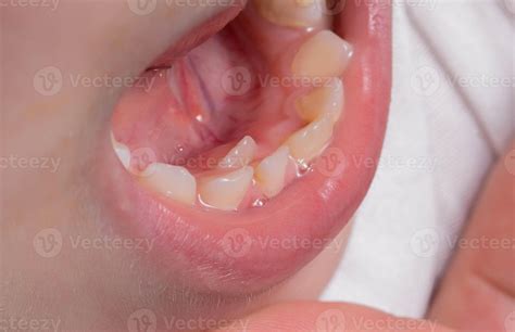 A child's tooth grows second next to the milk teeth. Formation of the