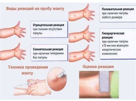 Вакцинация детей - презентация онлайн