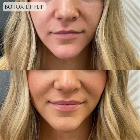 botox lip flip  achieve fuller lips  fillers bestskinscare