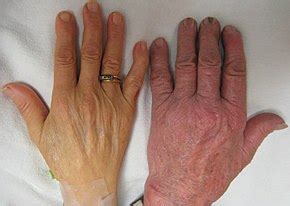anemia wikipedia le encyclopedia libere