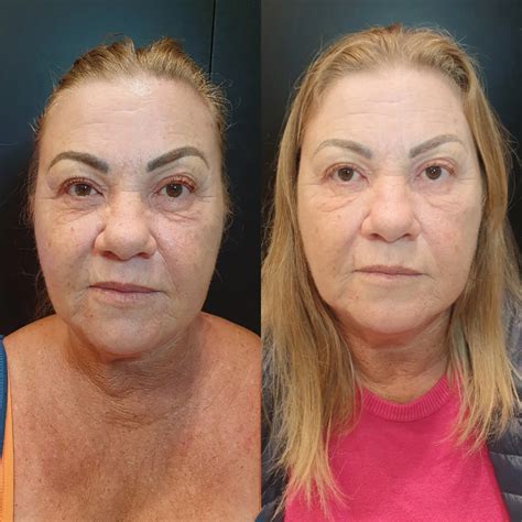 Exossomos Antes E Depois - Harmonização facial / Lentes de contato / Pdrn e exossomos ...