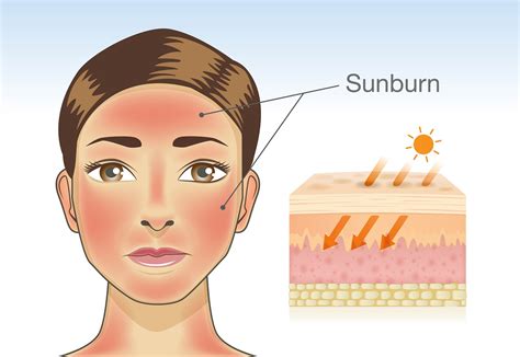 sunburn publications news  products  sunburn  credoweb