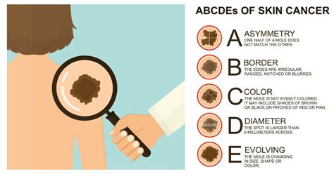 Could It Be Skin Cancer? The ABCDE Signs to Look For – SLMD Skincare by ...