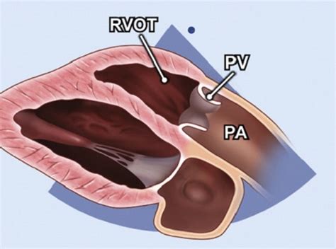 plax parasternal long axis echo techmed