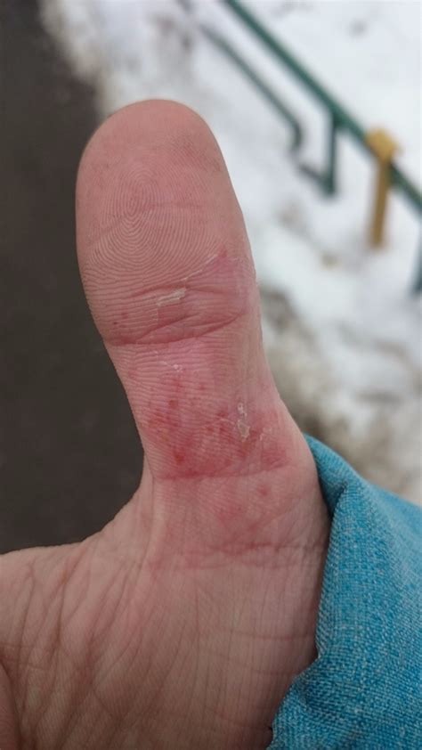 Волдыри на пальце - Вопрос дерматологу - 03 Онлайн